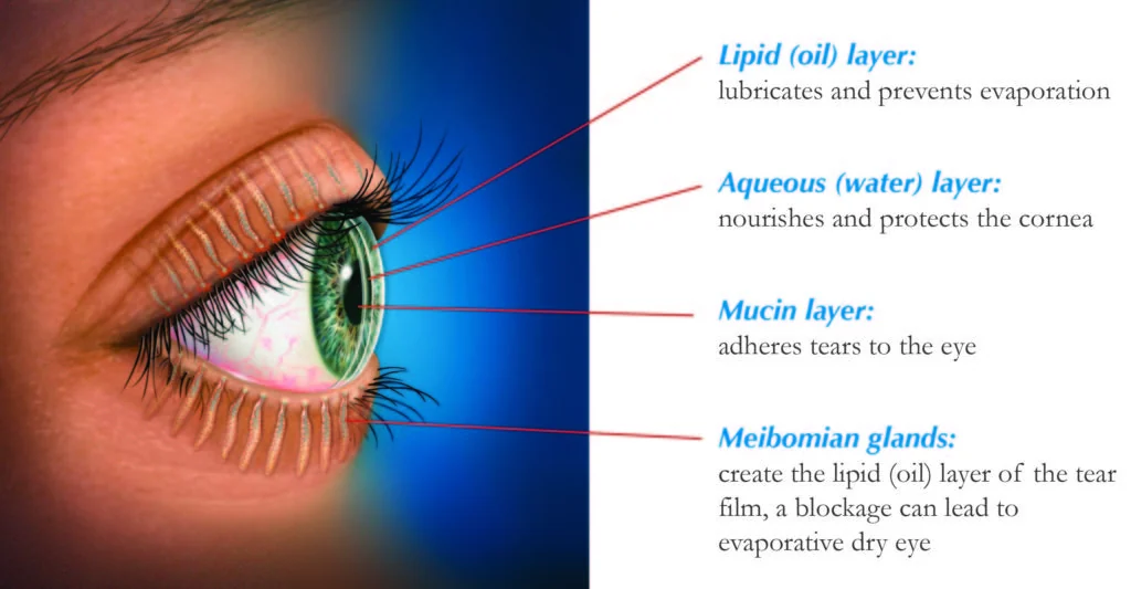 Diagram of the three layers of the tear film — the oily lipid layer, the watery aqueous layer and the mucin layer — over the surface of the eye